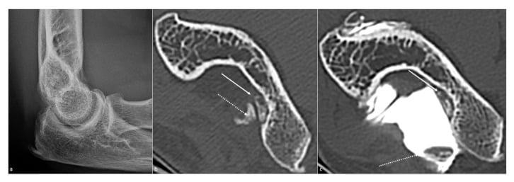 Elbow loose bodies on lateral radiograph, CT and CT arthrography