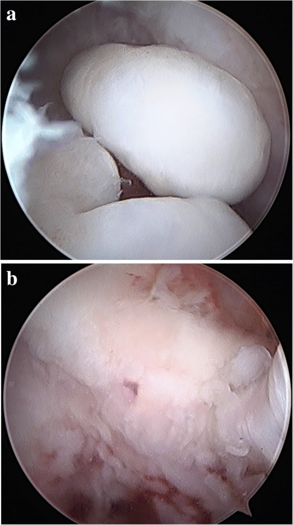 Arthroscopic removal of elbow loose bodies and fossa spur