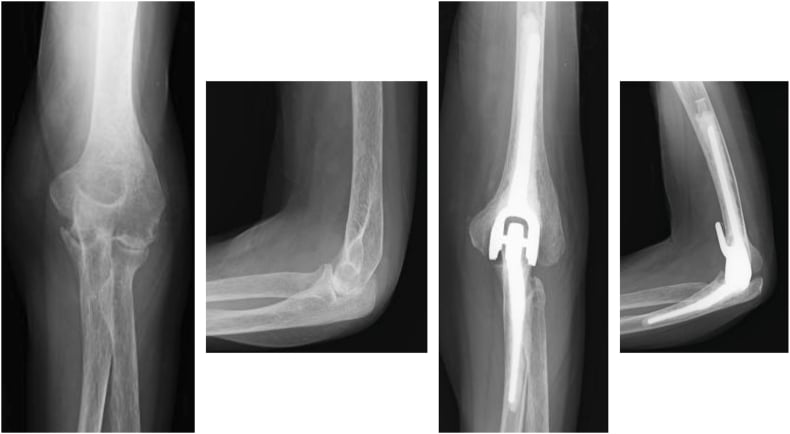 Rheumatoid elbow before and after total elbow arthroplasty
