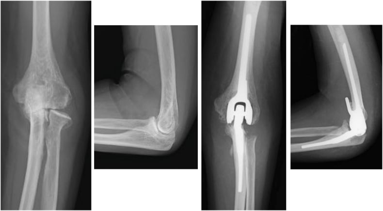 End-stage elbow osteoarthritis before and after arthroplasty