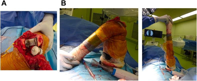 Linked total elbow arthroplasty components in the wound and the fluoroscopic motion check
