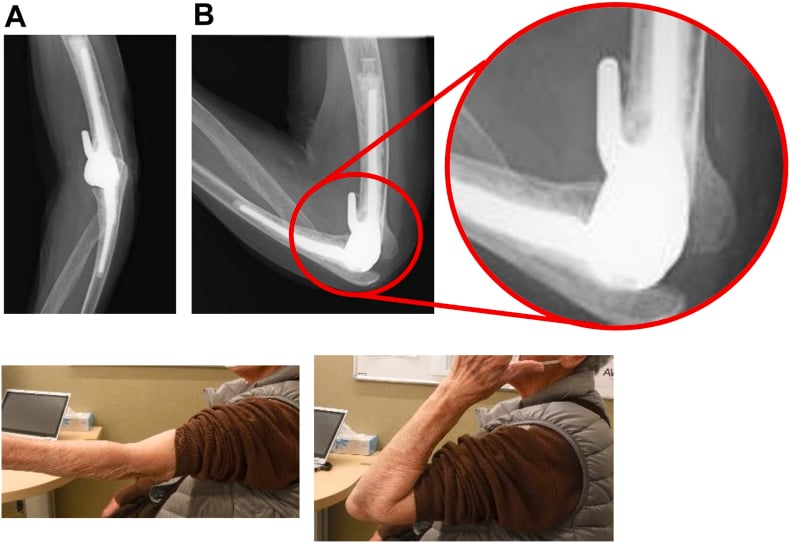 Extension and flexion radiographs and clinical photographs after elbow arthroplasty
