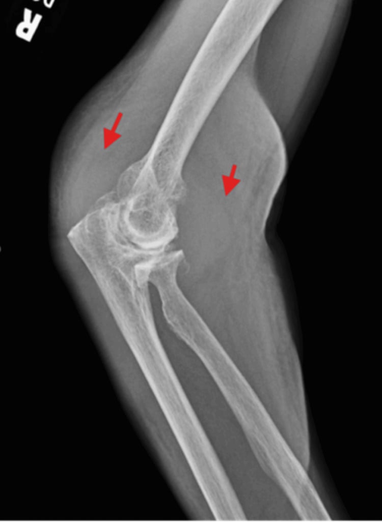 Elbow haemarthrosis with joint effusion on radiograph