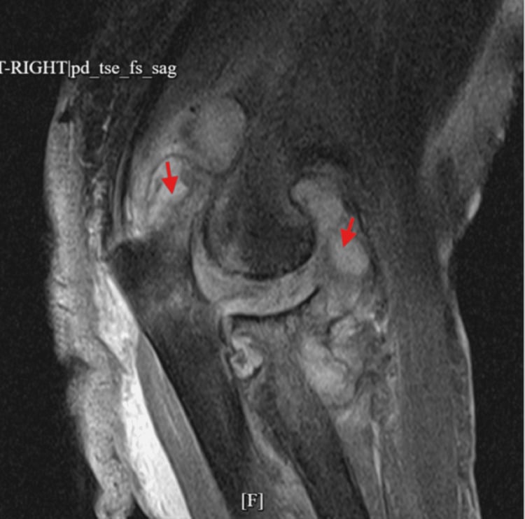 MRI of haemophilic elbow synovitis and haemarthrosis