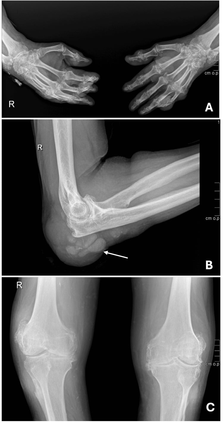 Tophaceous gout: radiographs of both hands, the right elbow with a mineralised posterior mass, and both knees