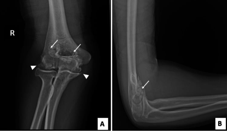 Elbow synovial chondromatosis with multiple loose bodies