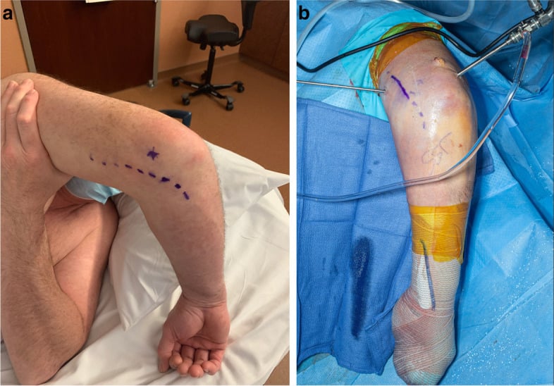 Mapping a transposed ulnar nerve before elbow arthroscopy