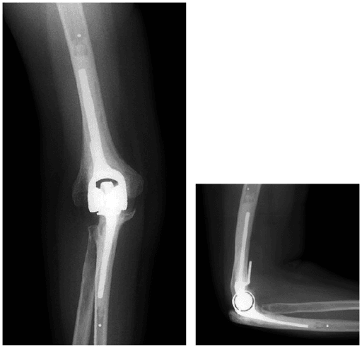 AP and lateral X-rays showing total elbow arthroplasty