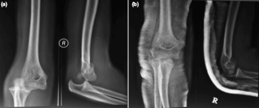 Posterior elbow dislocation with entrapped medial epicondyle