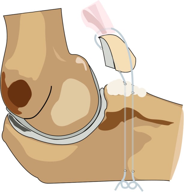 Diagram of transosseous suture lasso fixation of a coronoid tip fracture