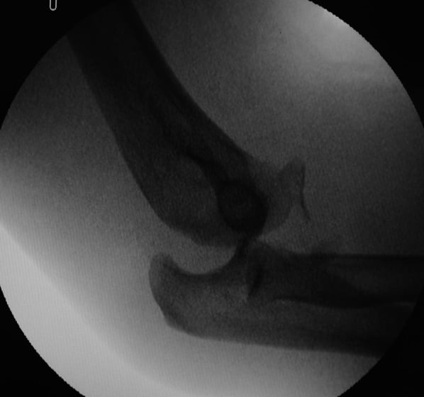 Fluoroscopy showing posterior ulnohumeral subluxation during examination under anaesthesia