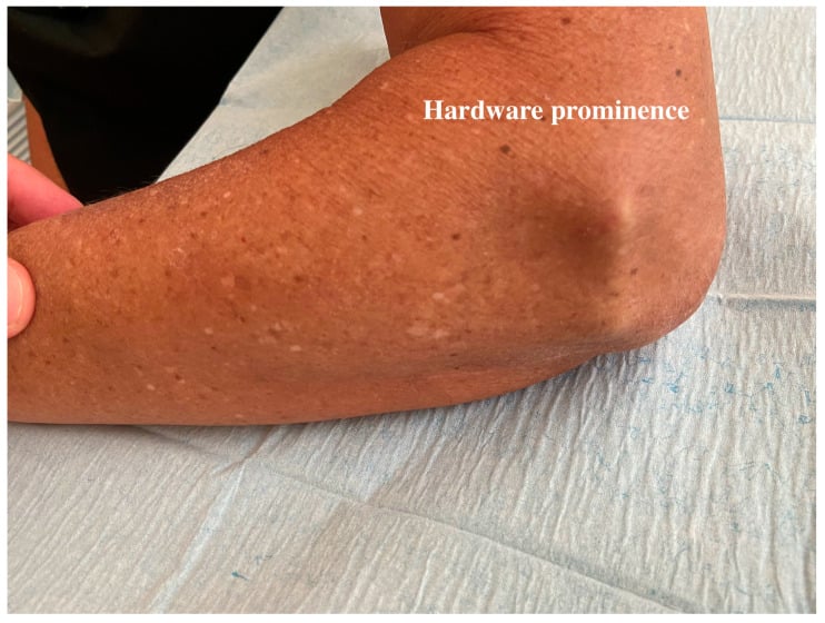 Clinical photograph showing symptomatic prominence of an elbow internal joint stabiliser