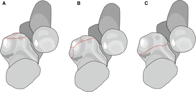 O Driscoll coronoid fracture classification viewed from above