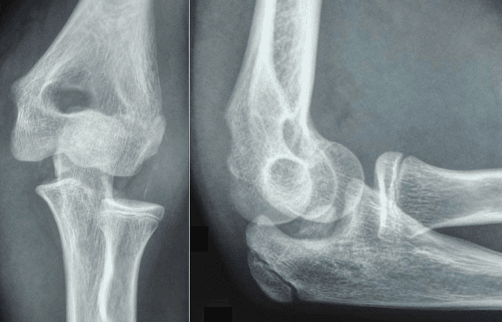 AP and lateral radiographs of a posterior elbow dislocation in an adult.