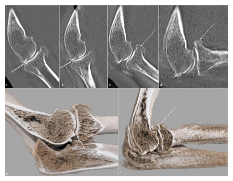 Sequential CT and specimen views showing osteophyte blocks through elbow motion