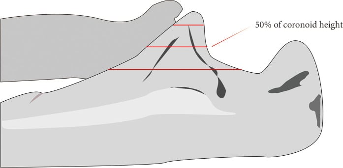 Regan Morrey classification by coronoid fracture height