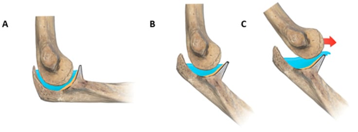 Diagram showing why semi-flexion reduces coronoid engagement and permits elbow dislocation