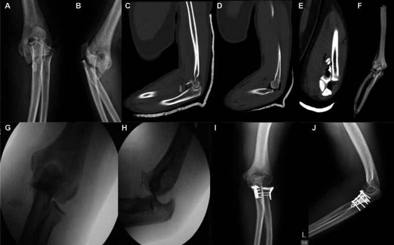 Radiograph CT and operative imaging sequence for a terrible triad elbow fracture dislocation