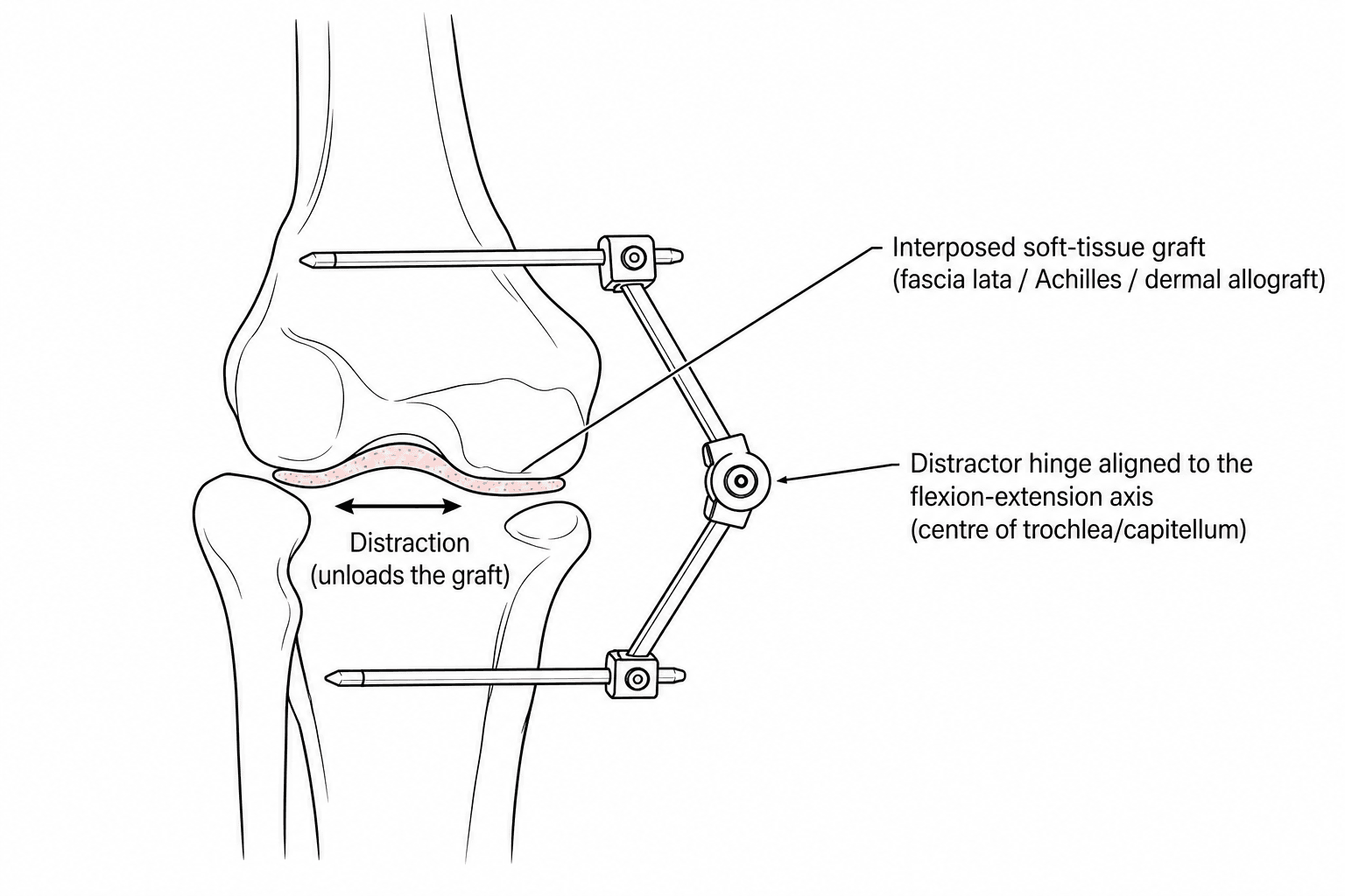 Diagram of the distraction interposition arthroplasty construct: an interposed soft-tissue graft over the distal humerus with a hinged distraction external fixator aligned to the flexion-extension axis