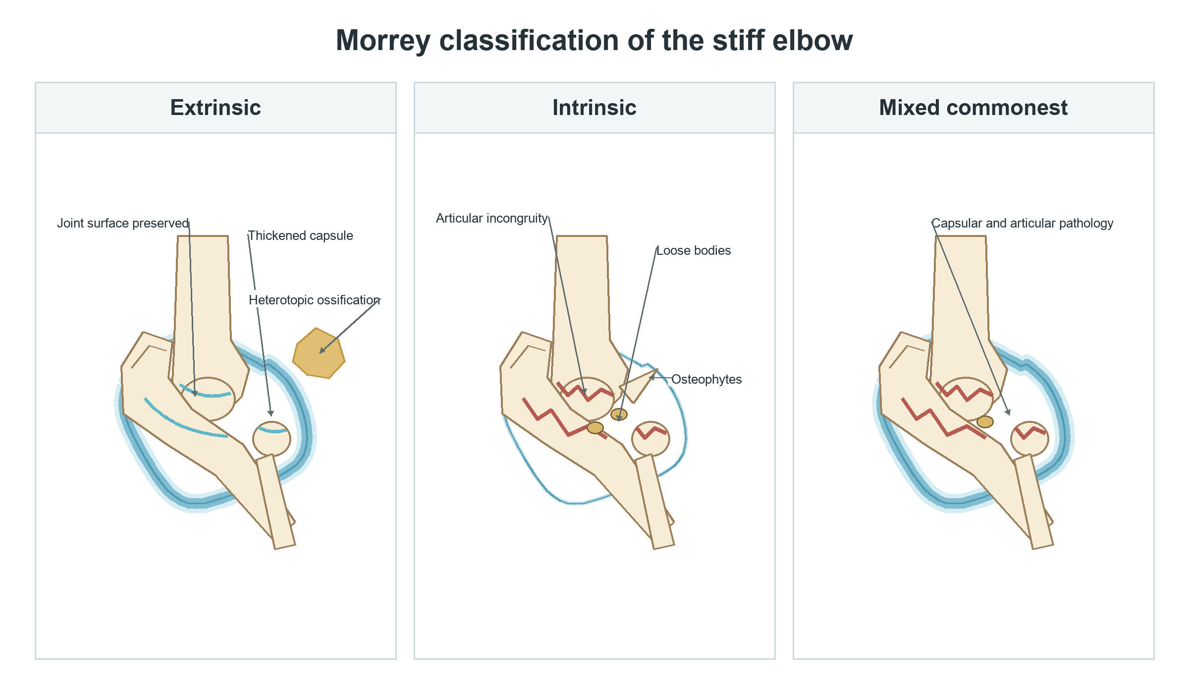 Three-panel schematic of the Morrey classification of the stiff elbow: extrinsic (thickened capsule and heterotopic ossification with a preserved joint surface), intrinsic (articular incongruity, loose bodies and osteophytes), and mixed (both).