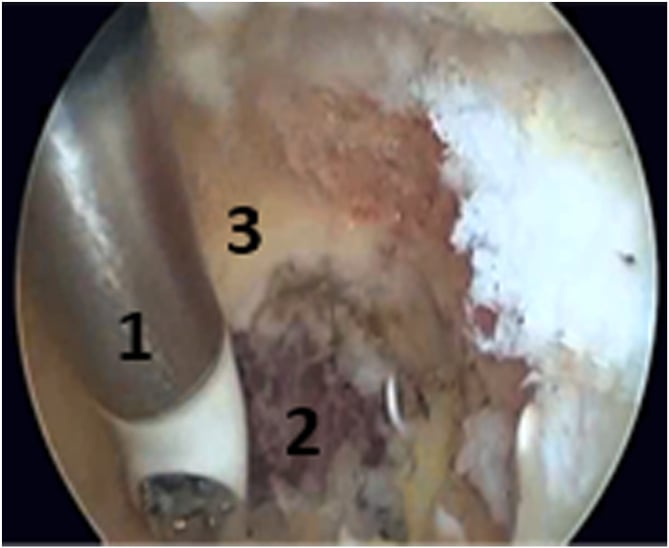 Arthroscopic anterior elbow capsulectomy through a humeral fenestration with radiofrequency release to the brachialis plane.
