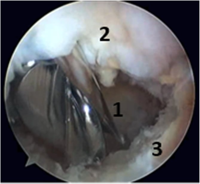 Arthroscopic view of a stiff elbow showing burr debridement of fibrous tissue and osteophytes in the posterior compartment.
