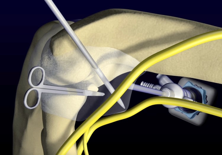 Schematic of arthroscopic anterior elbow capsular release showing a retractor protecting the neurovascular structures from the capsulotomy.