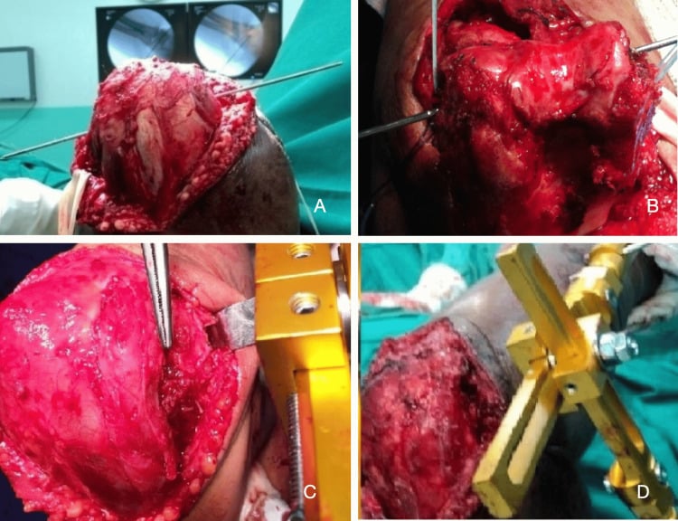 Operative sequence applying a dynamic hinged external fixator to the elbow with fluoroscopic guidewire placement and axis alignment.