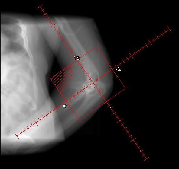 Management of heterotopic ossification: radiotherapy treatment planning field outlined over a flexed elbow for HO prophylaxis