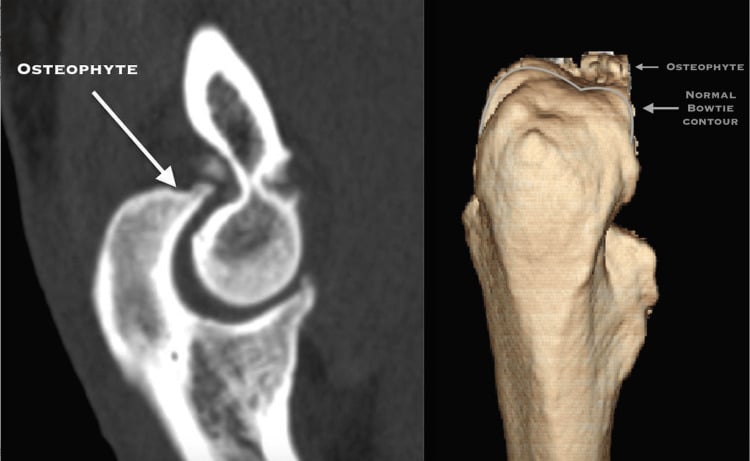 Sagittal CT and three-dimensional reconstruction of a stiff elbow showing an impinging osteophyte at the anterior distal humerus.