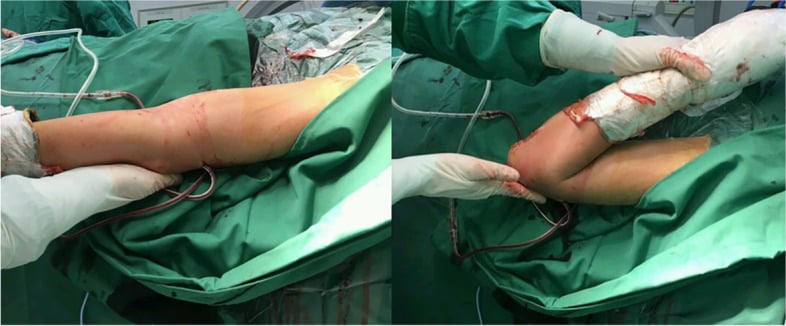 Intraoperative photographs showing passive elbow extension and flexion being checked under direct vision after open arthrolysis.