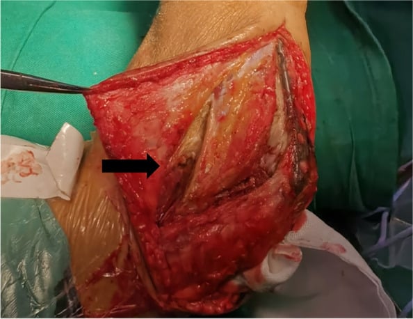 Operative photograph of the lateral column procedure through a partial extensor digitorum communis split for elbow arthrolysis.