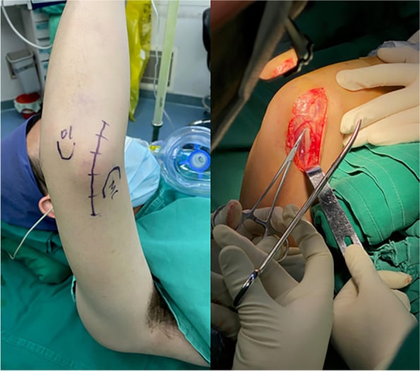 Operative photograph showing the medial incision used for combined medial-lateral open elbow arthrolysis.
