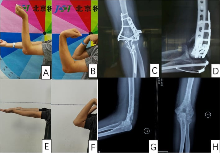 Clinical range-of-motion photographs and elbow radiographs before and after combined open arthrolysis for post-traumatic elbow stiffness.