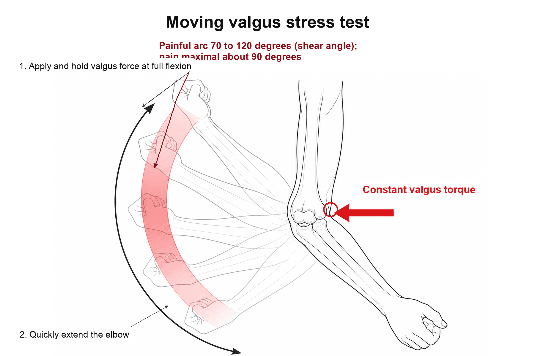 Schematic of the moving valgus stress test: forearm moving through an elbow flexion arc with a valgus force and the 70 to 120 degree painful shear-angle arc highlighted