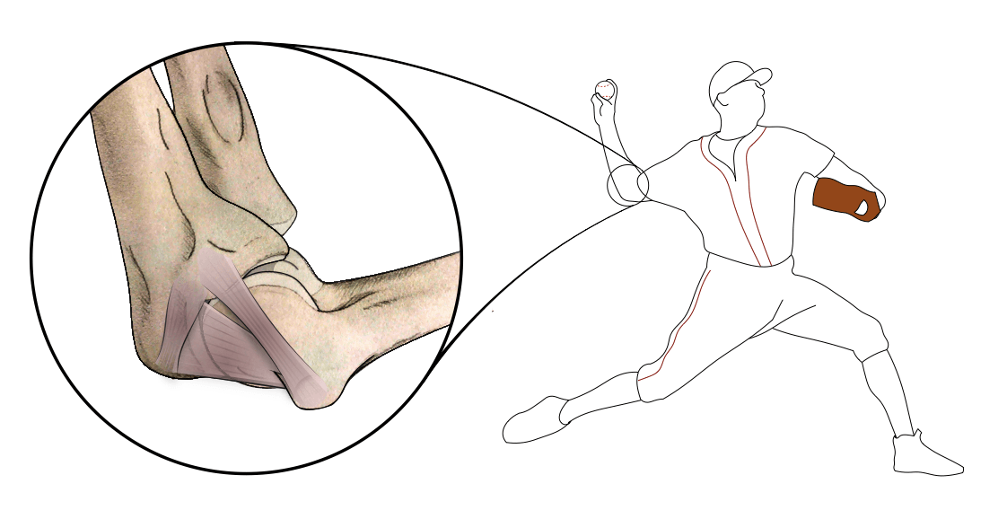 Illustration of a baseball pitcher with a magnified inset of the medial elbow showing the ulnar collateral ligament