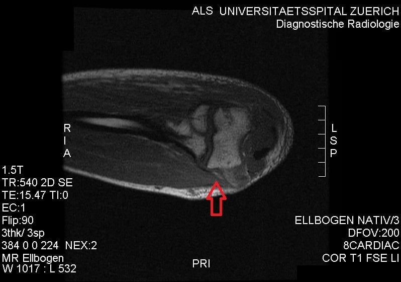 Coronal T1 MRI of the elbow with a red arrow at the ulnar collateral ligament humeral insertion