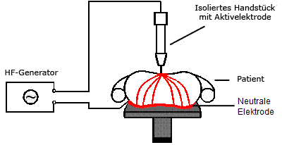 Monopolar diathermy circuit diagram