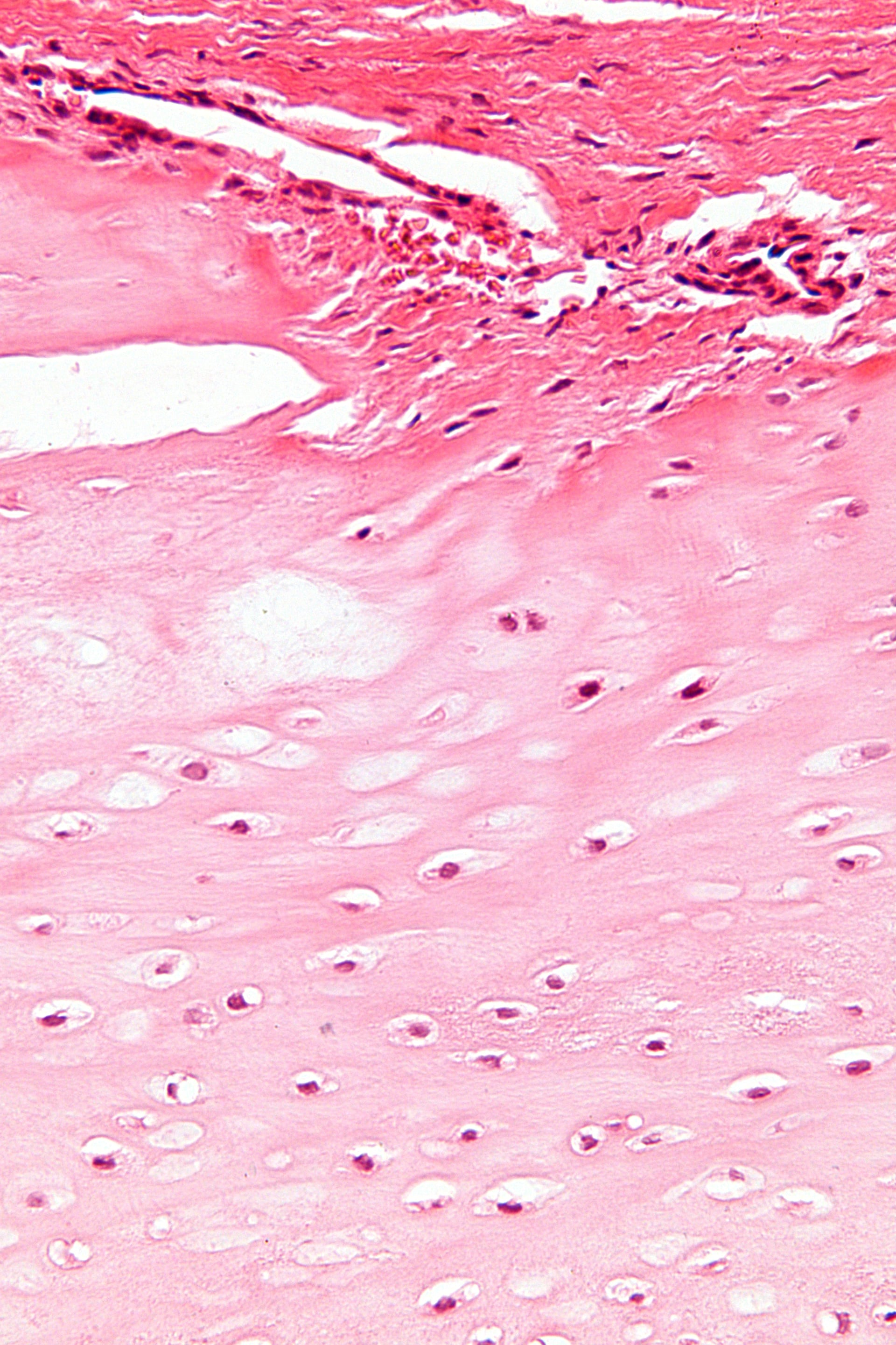 H&E histology of enchondroma showing hyaline cartilage with chondrocytes in lacunae.