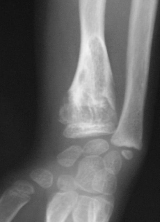 AP wrist radiograph showing expansile enchondromatous change in the distal radial metaphysis in Ollier disease