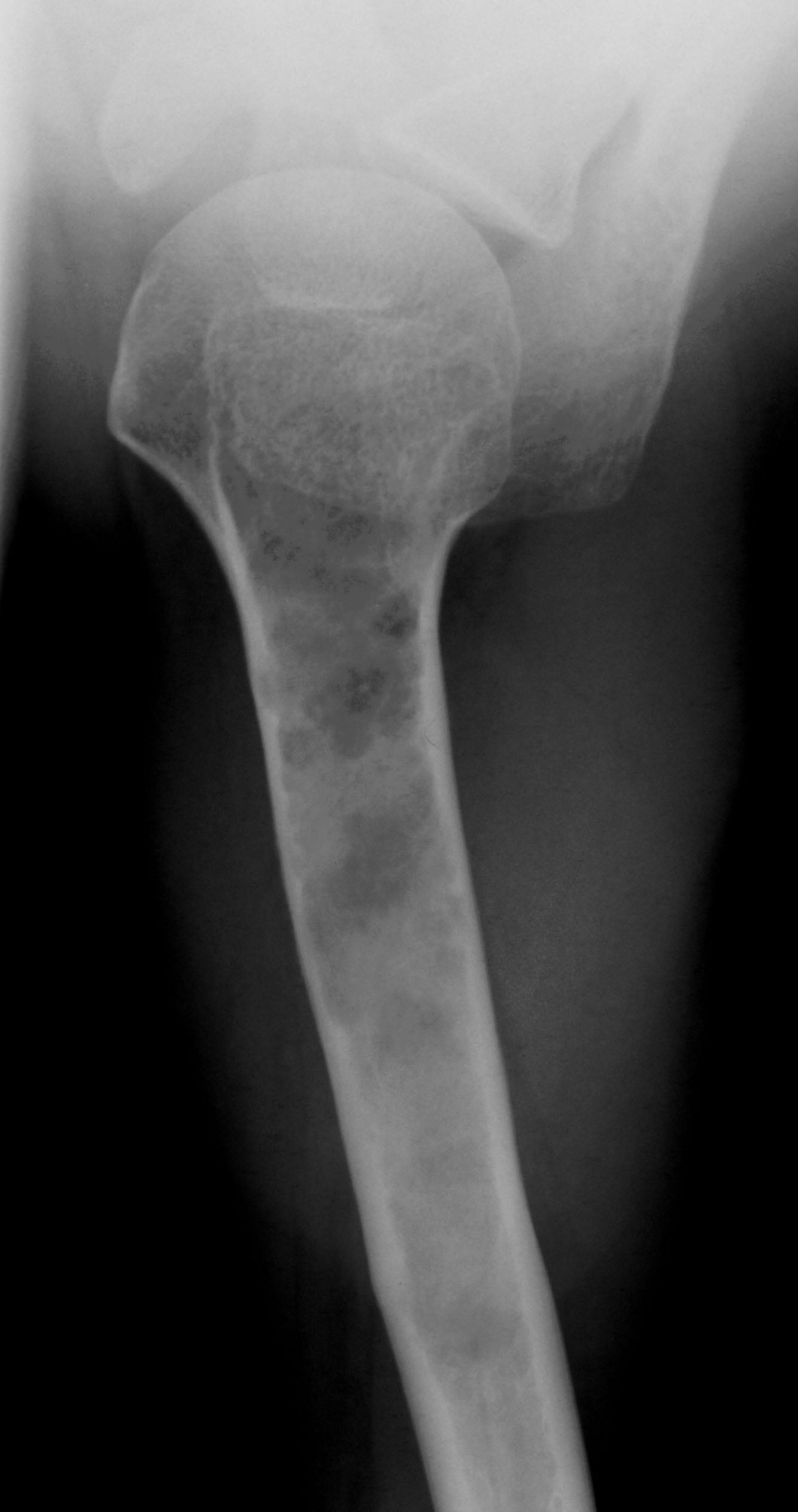 AP radiograph of proximal humerus showing extensive enchondromatosis in Ollier disease