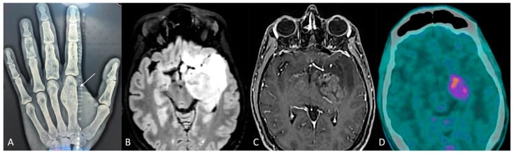 Hand radiograph with a first metacarpal enchondroma alongside brain MRI and PET-CT of an associated glioma