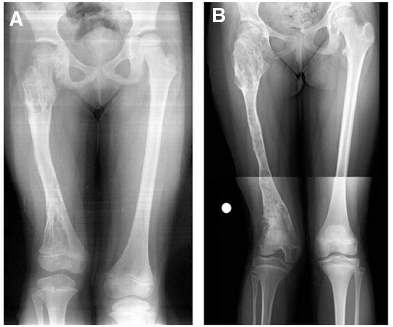 Radiographs at five and twelve years showing columnar cartilage lesions extending from three physes with partial ossification