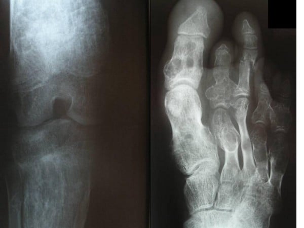 Knee radiograph with enlarged striated metaphyses and foot radiograph showing dysplastic metatarsals with a transverse phalangeal fracture