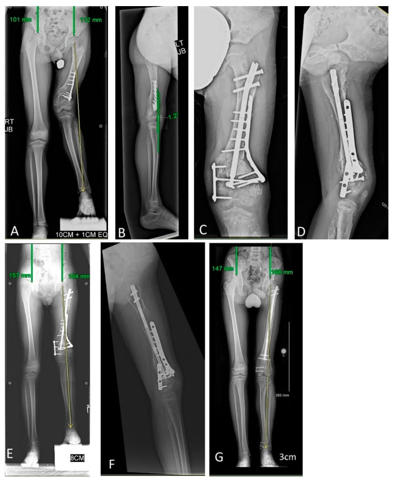 Full-length radiographs of an eight-year-old with Ollier disease before and after acute coronal correction with motorised intramedullary nail lengthening