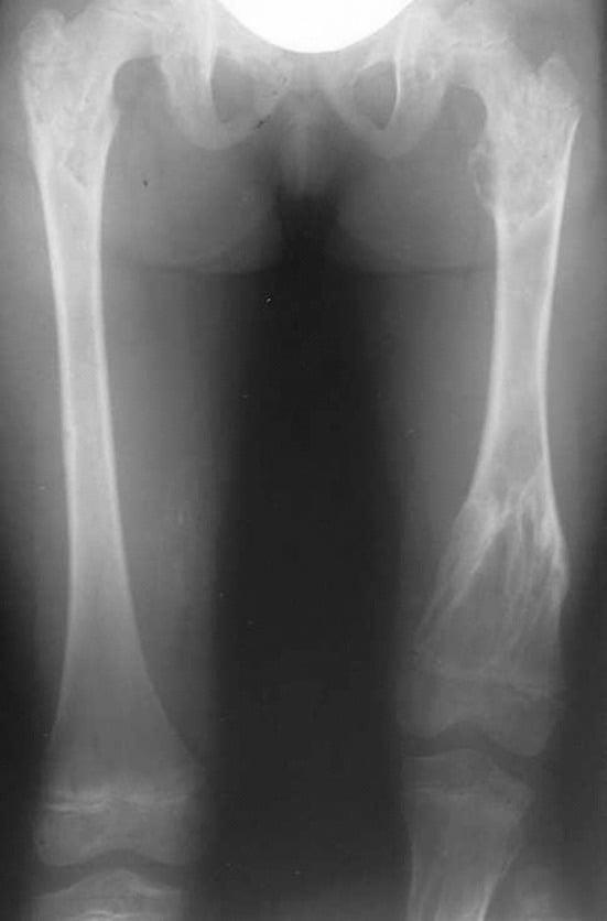 Radiograph of extensive enchondromatosis of the left femur in a child with Ollier disease before correction