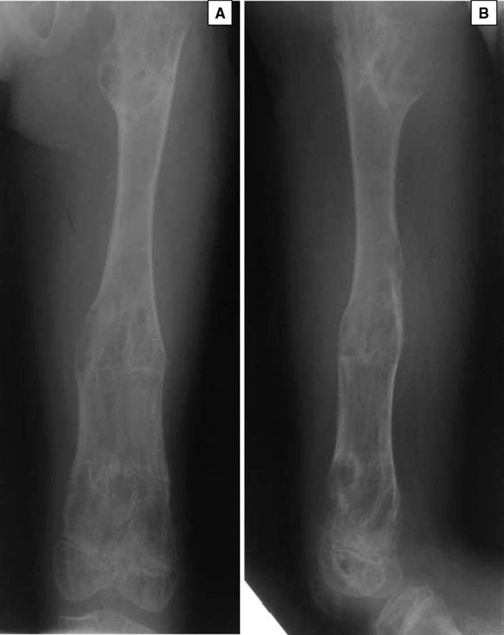 AP and lateral radiographs of the same femur after corrective surgery in Ollier disease