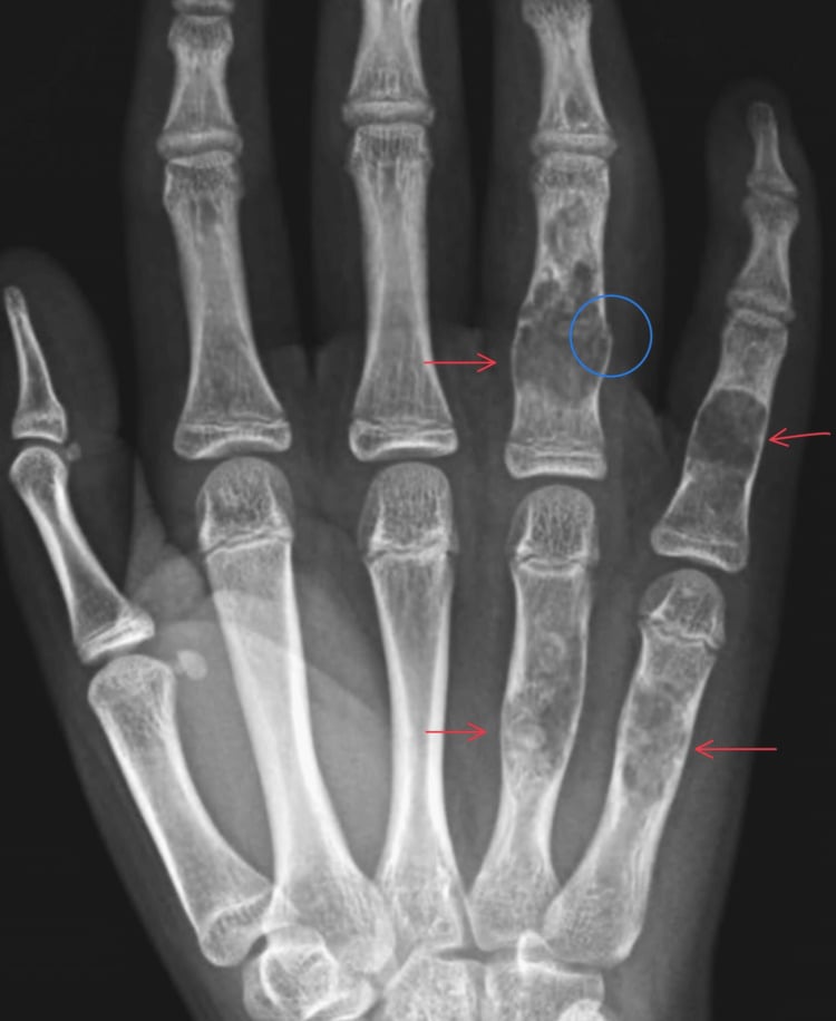 PA hand radiograph showing circumscribed expansile lytic phalangeal and metacarpal enchondromas with a nondisplaced cortical fracture