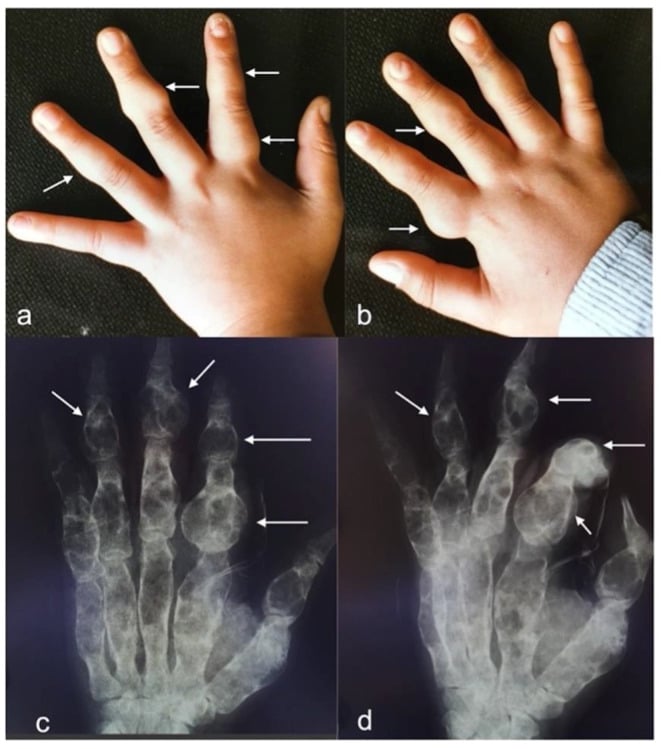 Photographs of both hands with multiple palpable bony nodules and matching radiographs of phalangeal enchondromas