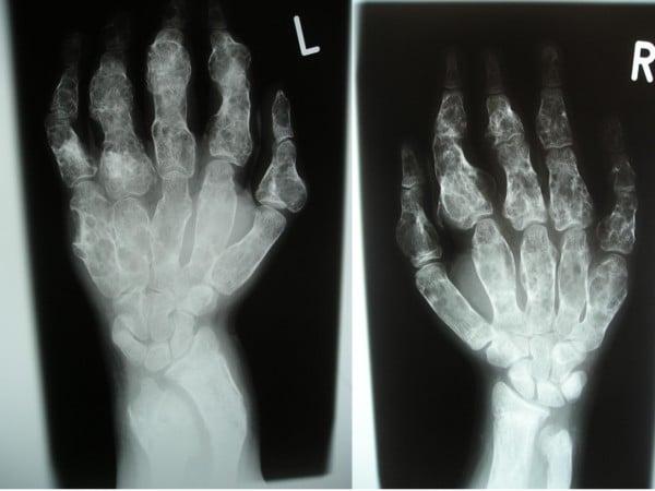 AP radiograph of both hands and forearms showing elongated radiolucent metaphyseal lesions with expanded metaphyses and shortened curved diaphyses